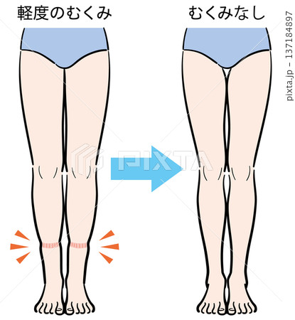 軽度のむくみ(靴下跡)からむくみなしへの変化 軽度のむくみ(靴下跡)からむくみなしへの変化 137184897