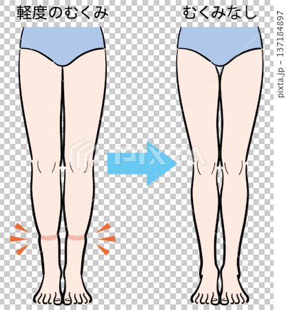 軽度のむくみ(靴下跡)からむくみなしへの変化 軽度のむくみ(靴下跡)からむくみなしへの変化 137184897