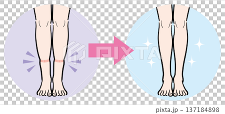 腿部輕微腫脹（襪子印記）轉變為完全消失 137184898