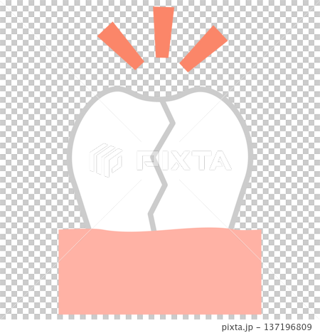 垂直性歯根破折のイラスト 歯のヒビや亀裂の歯科イメージ 垂直性歯根破折のイラスト 歯のヒビや亀裂の歯科イメージ 137196809