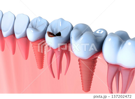 Dental implants instead of Damaged Teeth 137202472