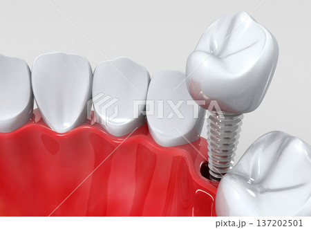 Dental implants instead of Damaged Teeth Dental implants instead of Damaged Teeth 137202501
