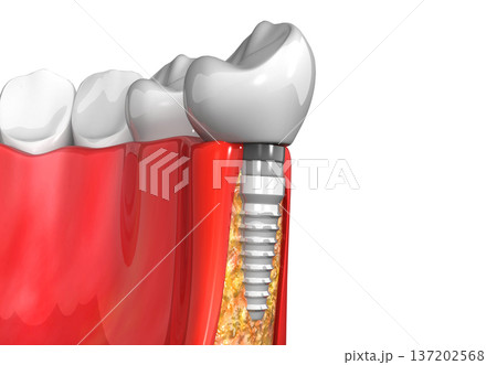 Dental implants instead of Damaged Teeth 137202568