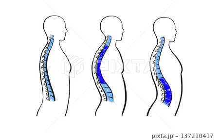 Scoliosis spine deformity Scoliosis spine deformity 137210417