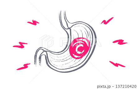 Gastroesophageal reflux pain 137210420