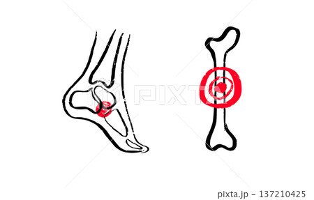 Osteomyelitis disease sketch 137210425