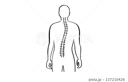 Scoliosis spine deformity 137210426