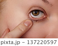 Closeup Eye Finger Pulling Lower Eyelid Revealing Irritated Sclera Faint Makeup Residue Detailed Skin Texture And Tear Film Conveying Discomfort Selfexamination And Vision Health Awareness 137220597