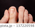 Closeup macro view of toe skin and nails. Nail detachment, fungal nail infection, onycholysis. Dermatologist or therapeutic pedicure examination, careful inspection of toenail condition, skin health 137220598