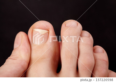 Closeup macro view of toe skin and nails. Nail detachment, fungal nail infection, onycholysis. Dermatologist or therapeutic pedicure examination, careful inspection of toenail condition, skin health Closeup macro view of toe skin and nails. Nail detachment, fungal nail infection, onycholysis. Dermatologist or therapeutic pedicure examination, careful inspection of toenail condition, skin health 137220598