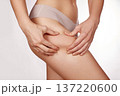 Woman Pinching Thigh Showing Cellulite Closeup Study Of Skin Texture And Dimples, Underwear Visible, Subtle Soft Lighting, Neutral Studio Background, Selfexamination Mood, Cosmetic Concern And Body 137220600