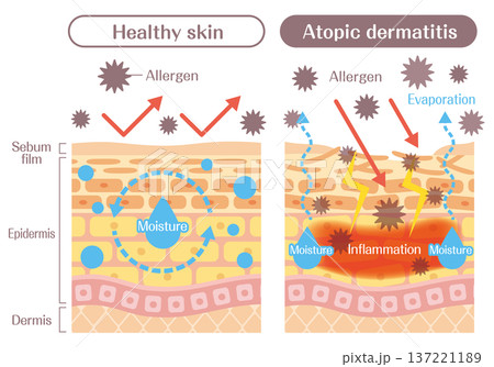 アトピー肌と健康な肌の違いを解説する皮膚構造イラスト（バリア機能・炎症・アレルゲン） 137221189