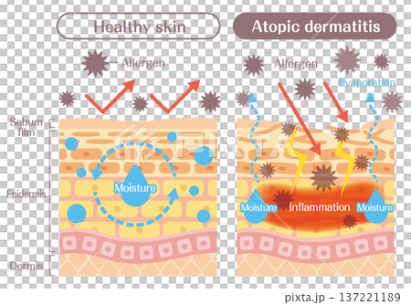 アトピー肌と健康な肌の違いを解説する皮膚構造イラスト（バリア機能・炎症・アレルゲン） 137221189