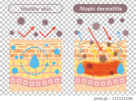 皮膚結構圖解，解釋了異位性皮膚炎皮膚和健康皮膚之間的差異（屏障功能、發炎、過敏原） 137221190