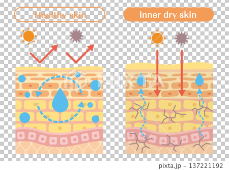 Illustration of skin structure (dryness and moisture balance) explaining the difference between inner dry skin and healthy skin 137221192