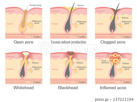 ニキビの発生過程と毛穴詰まりの説明図（白ニキビ・黒ニキビ・炎症） 137221194