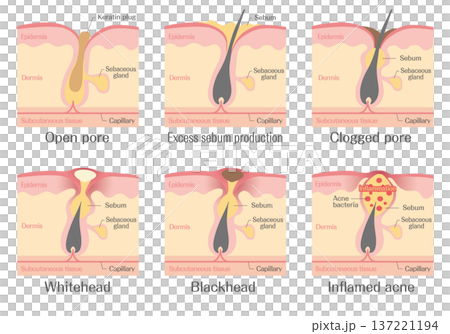 ニキビの発生過程と毛穴詰まりの説明図（白ニキビ・黒ニキビ・炎症） 137221194