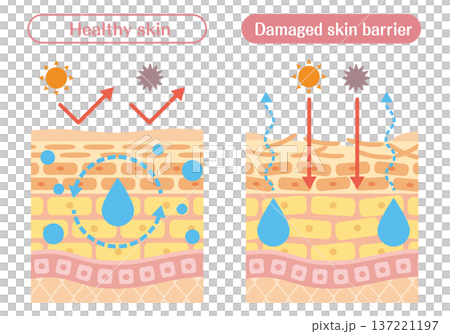肌のバリア機能が正常な状態と低下した状態の違いを解説する皮膚断面イラスト 肌のバリア機能が正常な状態と低下した状態の違いを解説する皮膚断面イラスト 137221197
