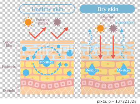 乾燥肌と健康な肌の違いを解説する皮膚構造イラスト(水分蒸発・外部刺激) 乾燥肌と健康な肌の違いを解説する皮膚構造イラスト(水分蒸発・外部刺激) 137221328