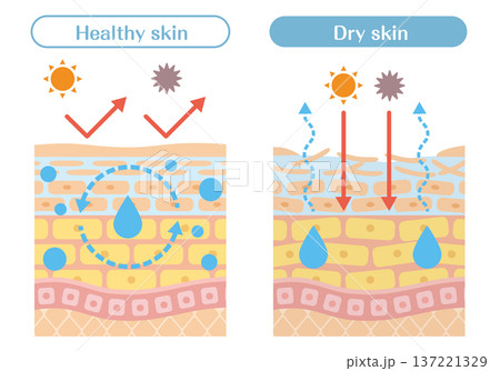 乾燥肌と健康な肌の違いを解説する皮膚構造イラスト（水分蒸発・外部刺激） 137221329