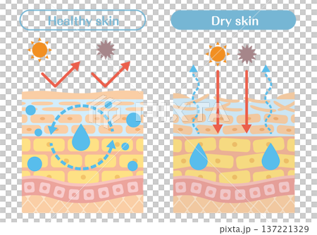 乾燥肌と健康な肌の違いを解説する皮膚構造イラスト（水分蒸発・外部刺激） 137221329