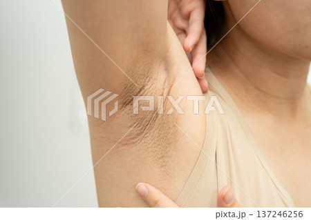 Asian woman have problem black armpit beauty skin care. Asian woman have problem black armpit beauty skin care. 137246256