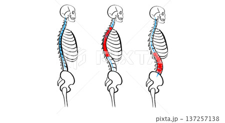 Scoliosis spine deformity 137257138