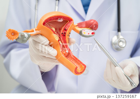 Uterus, doctor holding human anatomy model for study diagnosis and treatment in hospital. Uterus, doctor holding human anatomy model for study diagnosis and treatment in hospital. 137259167