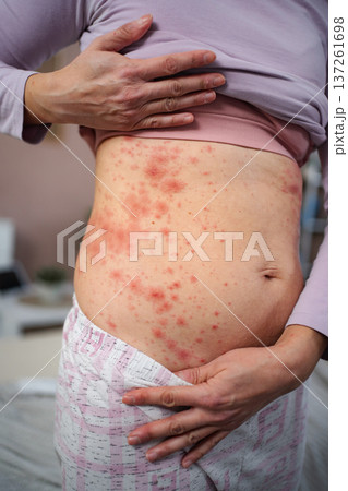 Woman showing red rash on stomach skin 137261698