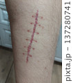Surgical suture on a man's leg after surgical treatment of a cut. Six stitches on the leg. Scar after stitch.  137280741
