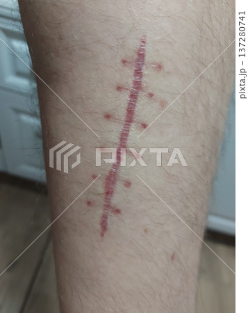 Surgical suture on a man's leg after surgical treatment of a cut. Six stitches on the leg. Scar after stitch.  137280741