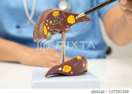 Cirrhosis, Liver cancer, fatty liver, Asian doctor with liver human model. Cirrhosis, Liver cancer, fatty liver, Asian doctor with liver human model. 137291168