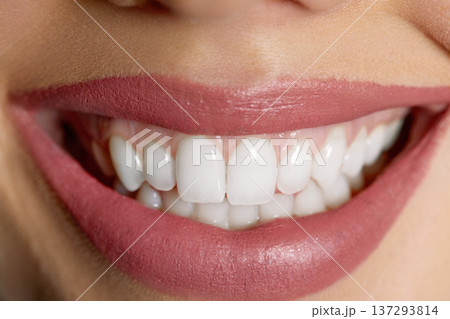 Perfect healthy teeth smile of a young woman. Teeth whitening. Dental clinic patient. Image symbolizes oral care dentistry, stomatology. 137293814