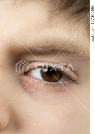 Allergic reaction and inflamed dry skin under eye area 137300696