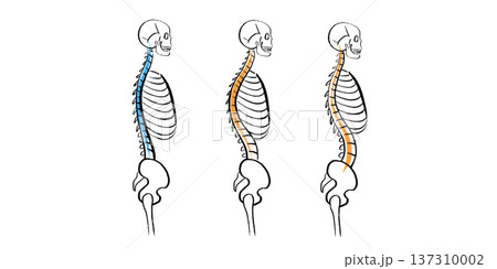 Scoliosis spine deformity 137310002