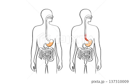 Gastroesophageal reflux pain Gastroesophageal reflux pain 137310009