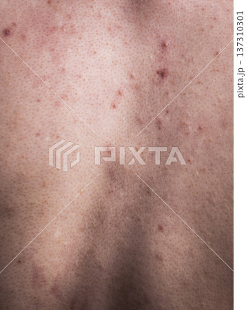 Closeup human skin with problem Closeup human skin with problem 137310301