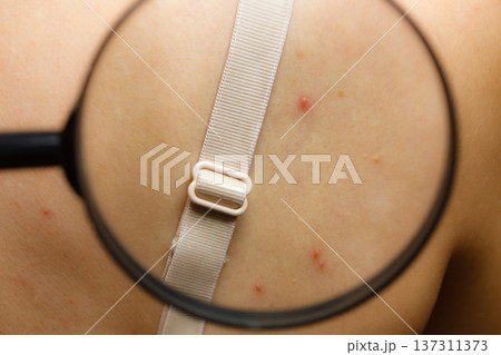 Closeup skin with acne moles and red spots. 137311373