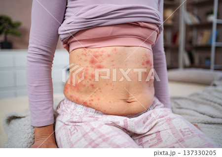 Woman's abdomen showing red rash, skin irritation, and allergy symptoms 137330205
