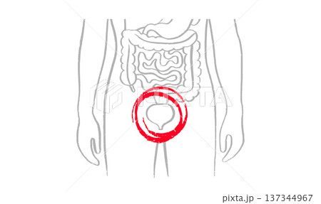 Bladder inflammation pain 137344967