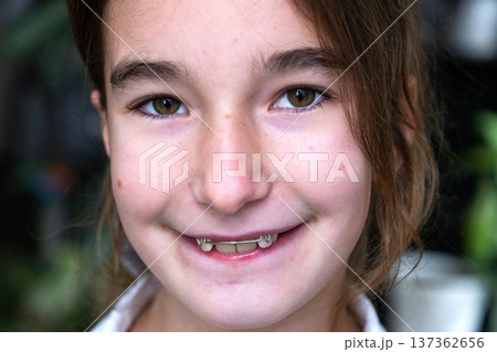 9 year old girl smiling after orthodontic treatment with removable plate, visible improved bite and teeth alignment, pediatric dental care. 137362656