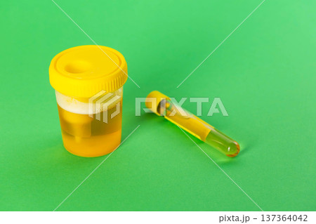 A test tube with reagent and urine on a green background. Bacterial culture for Enterobacteriaceae and Staphylococcus saprophyticus bacteria, which cause pain and inflammation in the urinary tract. A test tube with reagent and urine on a green background. Bacterial culture for Enterobacteriaceae and Staphylococcus saprophyticus bacteria, which cause pain and inflammation in the urinary tract. 137364042