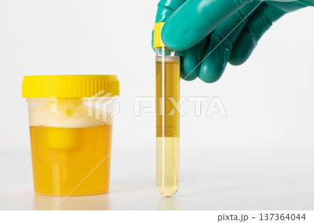 A laboratory technician's hand holds a test tube with urine for testing for bacterial culture and infections causing inflammation in the genitourinary system. Copy space for text A laboratory technician's hand holds a test tube with urine for testing for bacterial culture and infections causing inflammation in the genitourinary system. Copy space for text 137364044