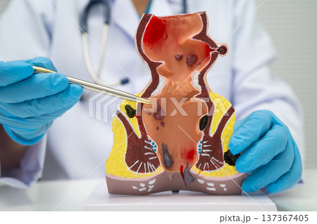 Asian doctor with rectum and hemorrhoid human anatomy model at hospital, inflamed vascular structure. 137367405
