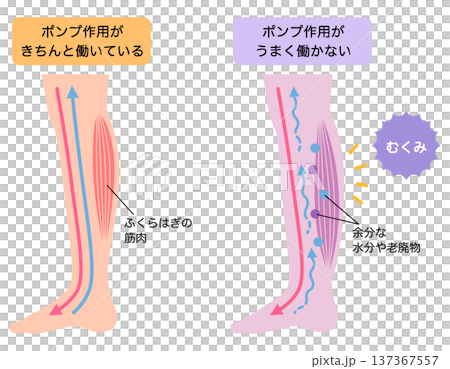 腿部腫脹：水腫的成因 137367557
