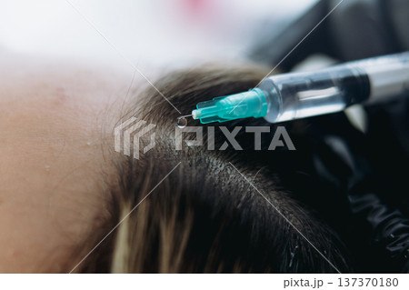 close up on woman head getting mesotherapy injections for stronger and healthier hair close up on woman head getting mesotherapy injections for stronger and healthier hair 137370180