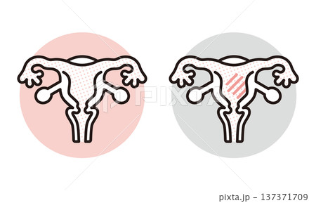 シンプル　イラスト　子宮の健康状態の比較イメージ 女性の健康 ベクターイラスト 137371709