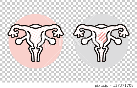 シンプル　イラスト　子宮の健康状態の比較イメージ 女性の健康 ベクターイラスト 137371709