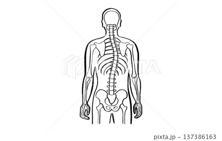 Scoliosis spine deformity 137386163