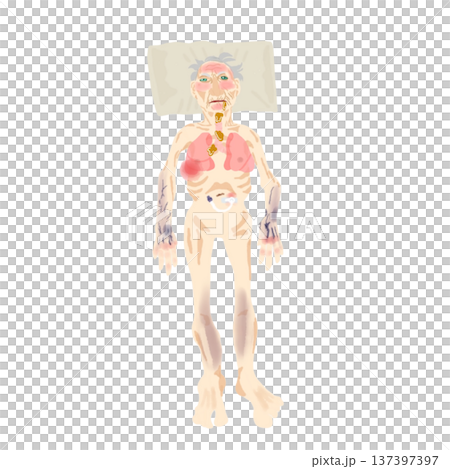 Elderly patient with pneumonia - Illustration of the overall condition of a bedridden patient Elderly patient with pneumonia - Illustration of the overall condition of a bedridden patient 137397397